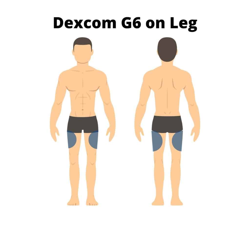 Can You Put Dexcom G6 on Your Leg